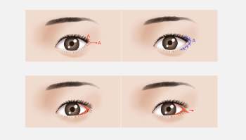 Mở góc mắt: Người sở hữu mắt một mí, mắt nhỏ, mắt ngắn hãy 