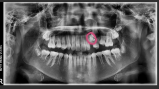 Mắc u răng hiếm gặp, bác sĩ lấy ra gần 20 chiếc răng trong khối u cho bé gái 12 tuổi