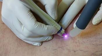 Có thể sử dụng liệu pháp laser để điều trị giãn mao mạch.