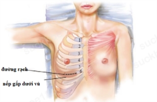 Nâng mũi sụn sườn, lấy sụn ở đâu? - ảnh 2