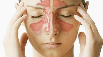 Nâng mũi có ảnh hưởng viêm xoang không? - ảnh 2