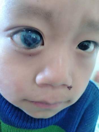 Mắt ngày càng lồi to, cậu bé dân tộc HMông nguy cơ bị mù vì không có tiền đi khám mắt - Ảnh 3.
