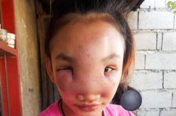 Nặn mụn trên mũi, cô gái 17 tuổi bất ngờ mắc bệnh lạ suốt 1 năm chưa khỏi - Ảnh 1