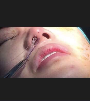 Cô gái hoại tử mũi vì tay nghề của bác sĩ mổ dạo - Ảnh 1