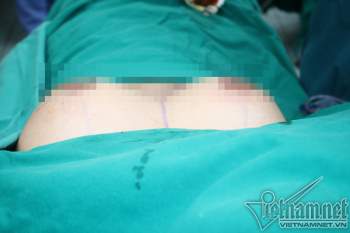 Ngực to gấp 4 người lớn, nữ sinh 14 tuổi phải phẫu thuật thu nhỏ