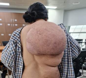 Người phụ nữ đeo khối u khổng lồ trên lưng trong suốt 30 năm - Ảnh 1