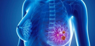 Những dấu hiệu ung thư dễ bị nhầm lẫn với các bệnh thông thường nhất, cần biết để phòng tránh - Ảnh 5