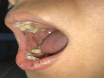 Phát hiện bệnh hiếm từ miệng có nhiều nốt sậm màu - ảnh 1