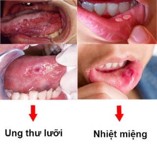 Dấu hiệu khác biệt giữa nhiệt miệng và ung thư lưỡi.