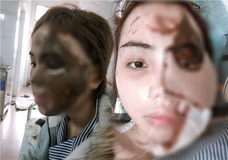 Cô gái Đà Nẵng bị chồng sắp cưới tạt axit gây rúng động: Ghép da lưng vào vùng mặt bị hủy hoại, đồng màu với da thật 80% - Ảnh 1.