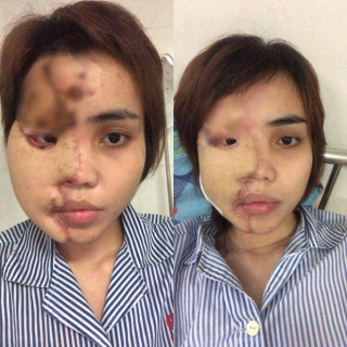Cô gái Đà Nẵng bị chồng sắp cưới tạt axit gây rúng động: Ghép da lưng vào vùng mặt bị hủy hoại, đồng màu với da thật 80% - Ảnh 3.