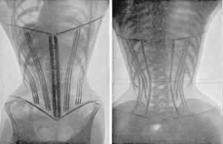 Đeo corset để giảm cân, giảm mỡ bụng sau sinh, một người bị bong tróc tử cung, nội tạng chảy xệ - Ảnh 5.