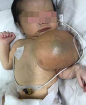 Cắt khối u khổng lồ ở ngực cho bé 3 ngày tuổi - Ảnh 1.