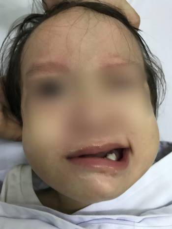 Bé gái 17 tháng tuổi đột ngột liệt mặt sau khi chảy mũi, ngạt mũi - Ảnh 1.