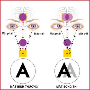 Nguyên nhân và hướng điều trị bệnh song thị, chứng nhìn một vật thành hai hình - Ảnh 1.