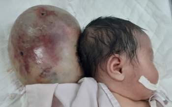 Cắt khối u khổng lồ như cái đầu thứ 2 cho bé sơ sinh - Ảnh 1.