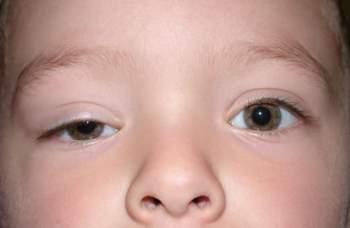 Sụp mí mắt là dấu hiệu của bệnh lý nguy hiểm - Ảnh 1.
