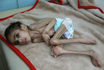 Cậu bé Yemen 7 tuổi nặng 7 kg - Ảnh 2.