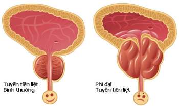 Quý ông đi tiểu nhiều coi chừng mắc căn bệnh siêu khó chịu này - Ảnh 2.