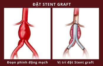  Người đàn ông mạch máu khổng lồ suýt vỡ được cứu như thế nào? - Ảnh 1.