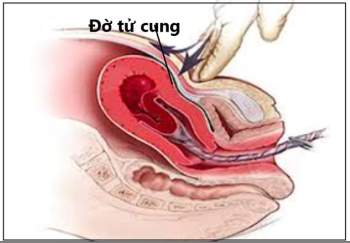 Cứu sống sản phụ bị đờ tử cung nguy hiểm tính mạng sau sinh thường - Ảnh 1.