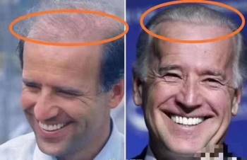 76 tuổi vẫn phong độ lịch lãm, ông Joe Biden để lộ bằng chứng nhiều lần phẫu thuật níu kéo tuổi xuân từ cấy tóc, căng da đến cắt mí - Ảnh 4.