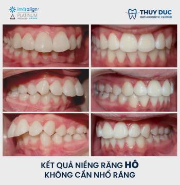 4 điều ba mẹ cần làm nếu muốn con niềng không phải nhổ răng - Ảnh 3.