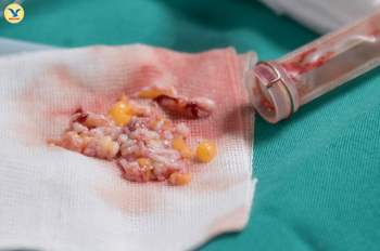 Sinh thiết vú, hút chân không loại bỏ khối u nhanh ở BVĐK MEDLATEC - Ảnh 4.