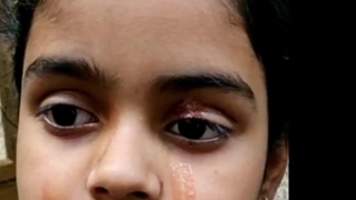 Giải mã bí ẩn của haemolacria: Chứng bệnh khiến những cô gái Ấn Độ khóc ra máu - Ảnh 7.