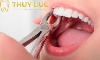Phương pháp niềng răng không đau tại nha khoa Thúy Đức