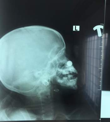 Nhét pin vào mũi, bé gái 4 tuổi bị axit phá hủy niêm mạc - Ảnh 1.