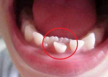 Kéo răng từ vòm họng ra ngoài hàm răng: Tưởng chỉ là trò đùa hóa ra đây là một phương pháp nắn chỉnh răng! - Ảnh 4.