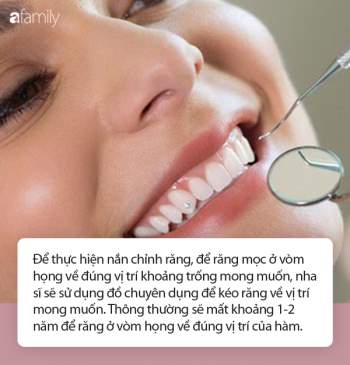 Kéo răng từ vòm họng ra ngoài hàm răng: Tưởng chỉ là trò đùa hóa ra đây là một phương pháp nắn chỉnh răng! - Ảnh 3.