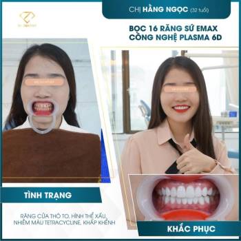 Plasma 6D – Đột phá mới trong phục hình răng sứ siêu tương thích - 3