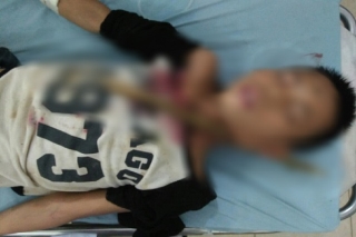 Sơn La: Bé trai 12 tuổi bị cành cây đâm xuyên cổ