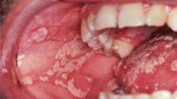 Nấm miệng là bệnh lành tính và hiếm khi gây ra các triệu chứng nguy hiểm.