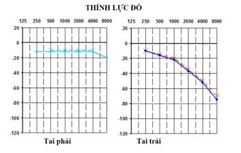 Chóng mặt, nghe kém, phát hiện u trong não - Ảnh 2.