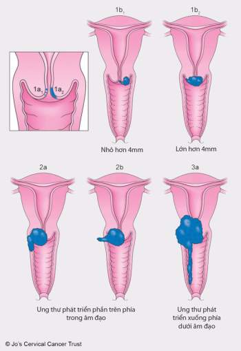 Ung thư cổ tử cung gây Tu vong cao thứ 3 ở phụ nữ: Dấu hiệu cảnh báo, người có nguy cơ cao mắc phải và các giai đoạn phát triển bệnh - Ảnh 8.