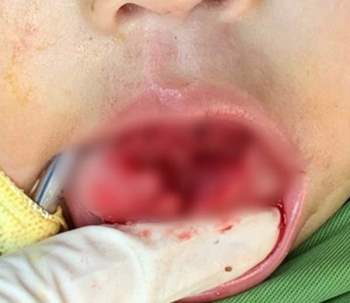 Trẻ một tuổi bị T*i n*n rách lưỡi từ nguyên nhân bố mẹ nào chủ quan - Ảnh 1.
