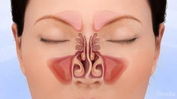 Phẫu thuật vẹo vách ngăn mũi: Hiệu quả không chỉ là thẩm mỹ mà còn ngăn chặn nhiều biến chứng nguy hiểm - Ảnh 1.