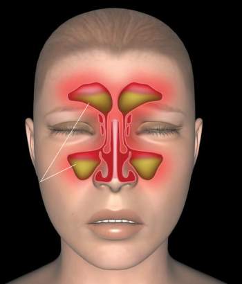 Phẫu thuật vẹo vách ngăn mũi: Hiệu quả không chỉ là thẩm mỹ mà còn ngăn chặn nhiều biến chứng nguy hiểm - Ảnh 6.