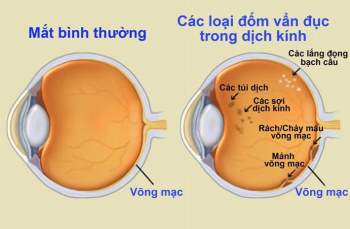 Vẩn đục dịch kính