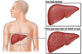 Viêm gan mạn tính kéo dài dễ dẫn đến xơ gan, thậm chí ung thư gan.