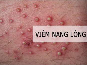 Hè gõ cửa, cẩn trọng các bệnh đe doạ nhan sắc chị em - Ảnh 2.