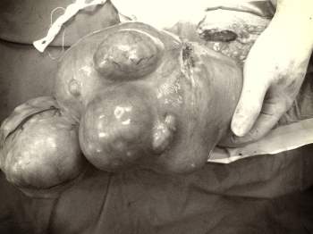Giải phóng khối u khủng trong ổ bụng bệnh nhân tương đương cân nặng một em bé mới sinh - Ảnh 1.