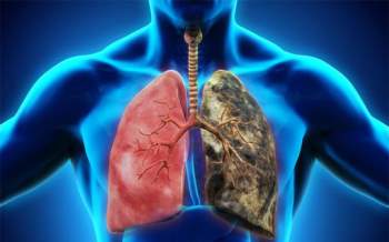 6 nhóm người có nguy cơ mắc ung thư phổi cao nhất