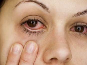 Cách xử lý khi bị đau mắt đỏ