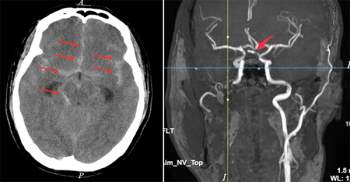 Kết quả CT và MRI cho thấy bệnh nhân bị xuất huyết dưới nhện do túi phình bị vỡ ở vị trí động mạch thông trước