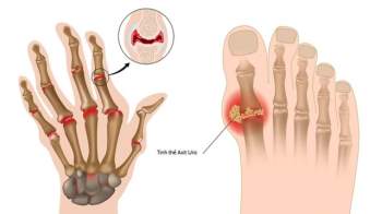 Người mắc bệnh gout có phải kiêng ăn trứng không? - Ảnh 2.