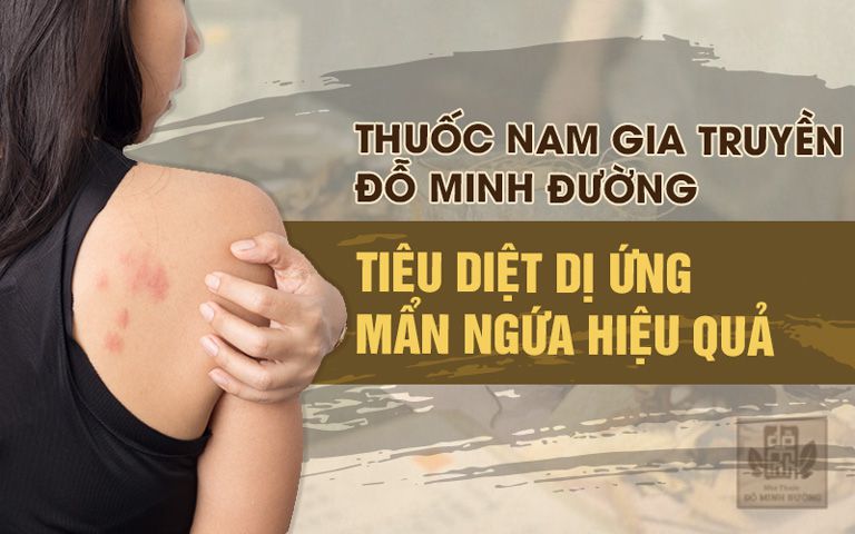 Bài thuốc Mề đay Đỗ Minh chữa dứt điểm bệnh dị ứng, mề đay mẩn ngứa